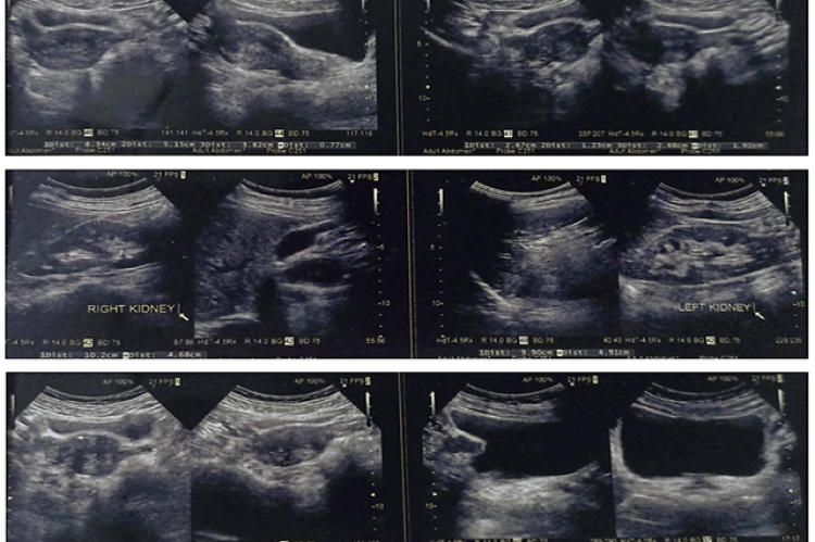 Real-time ultrasound sonography of abdomen and pelvis pre treatment