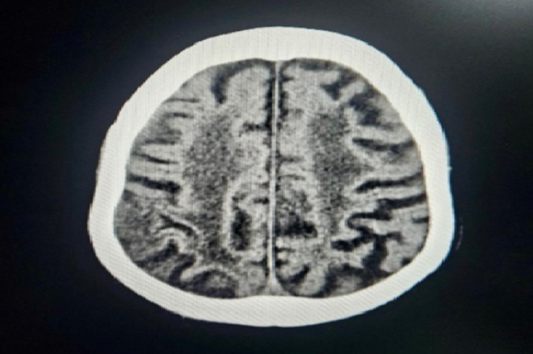 Magnetic resonance imaging of a man patient aged 78. On T2/FLAIR imaging, extensive periventricular hyperintense regions were also observed, which may indicate small vessel alterations. They describe gliotic alterations in the left upper frontal lobe.