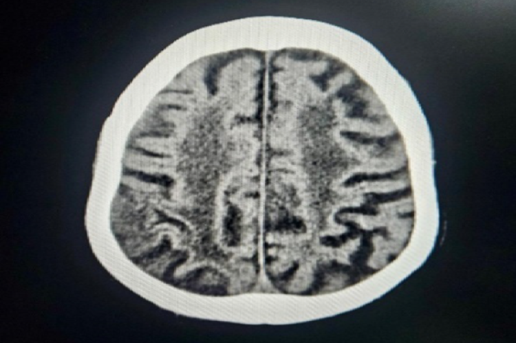 Magnetic resonance imaging of a man patient aged 78. On T2/FLAIR imaging, extensive periventricular hyperintense regions were also observed, which may indicate small vessel alterations. They describe gliotic alterations in the left upper frontal lobe.