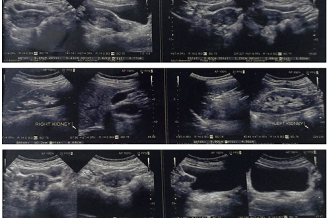 Real-time ultrasound sonography of abdomen and pelvis pre treatment