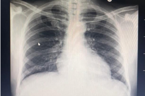 Chest X-ray.