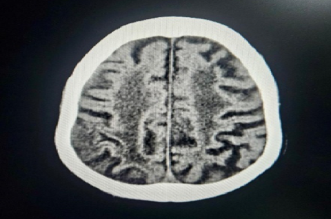 Magnetic resonance imaging of a man patient aged 78. On T2/FLAIR imaging, extensive periventricular hyperintense regions were also observed, which may indicate small vessel alterations. They describe gliotic alterations in the left upper frontal lobe.